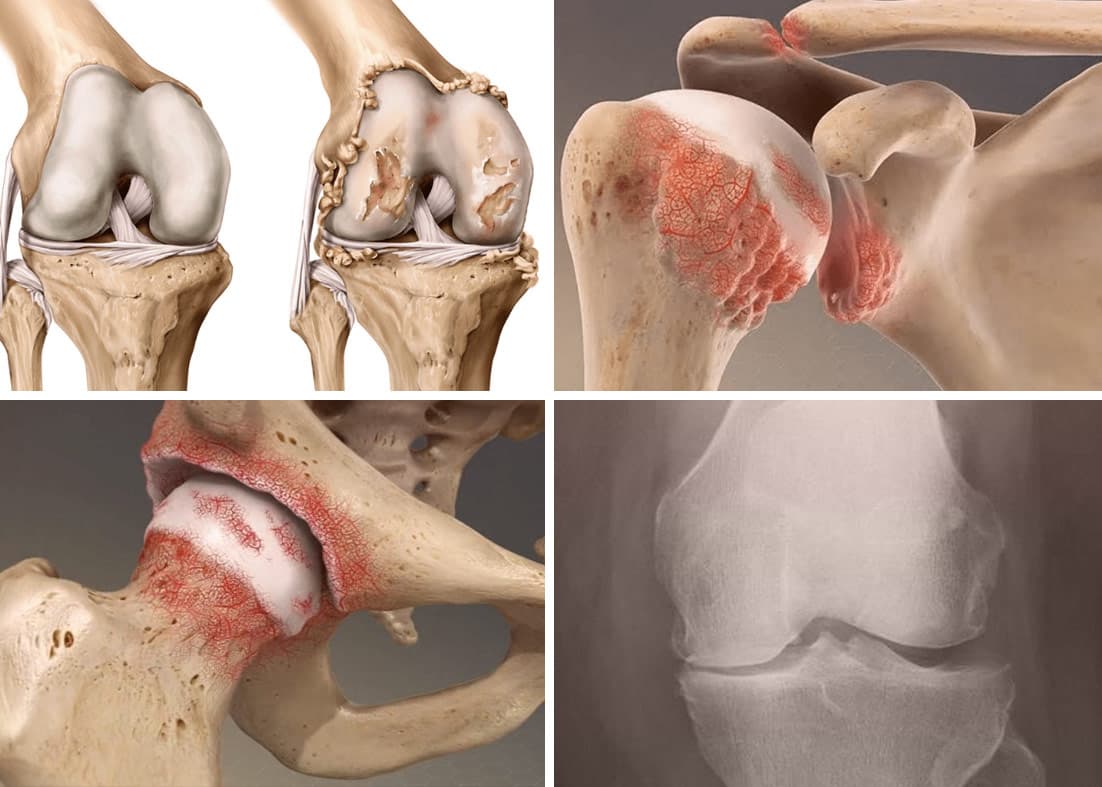 Imagem ilustrativa sobre Artrose na reumatologia