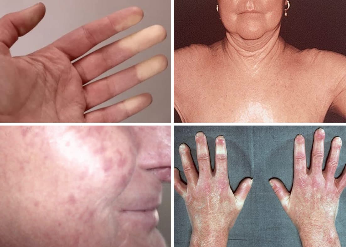 Imagem ilustrativa sobre Esclerose sistêmica na reumatologia
