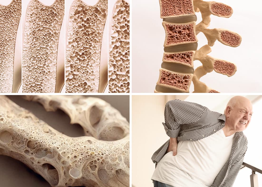 Imagem ilustrativa sobre Osteoporose na reumatologia