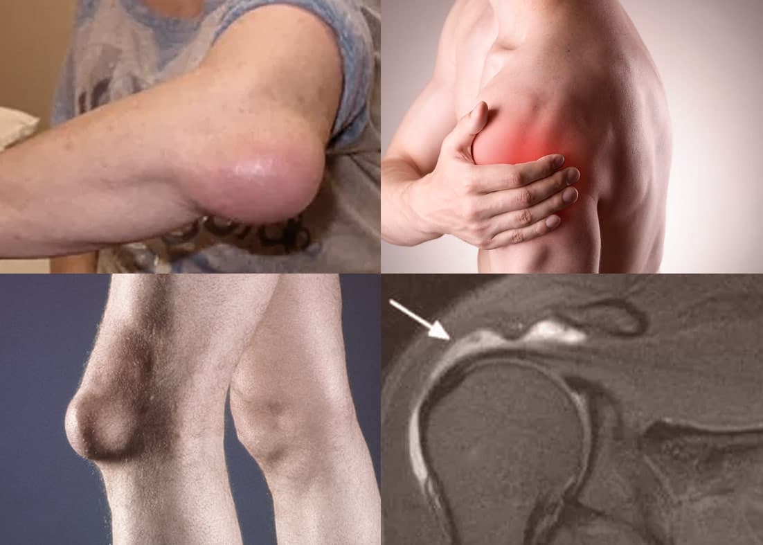 Imagem ilustrativa sobre Tendinites e bursites na reumatologia